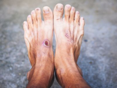 Îngrijirea piciorului diabetic Îngrijirea piciorului diabetic